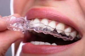 clear-aligners-appleton-wi