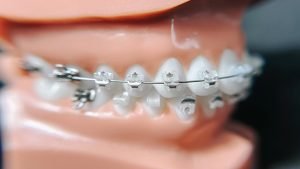 Braces in Appleton WI - Applecreek Orthodontics