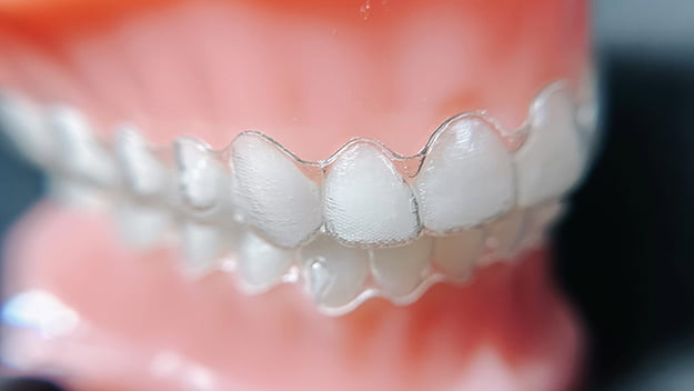 Clear Aligners in Appleton WI - Applecreek Orthodontics