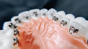 Lingual Braces in Appleton WI - Applecreek Orthodontics