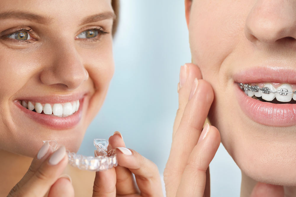 2 smiling young women demonstrate traditional braces and Invisalign® Clear Retainers